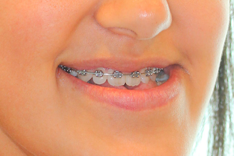 Antes
